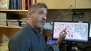 Intersticio: el nuevo órgano que puede ayudar a entender la propagación del cáncer