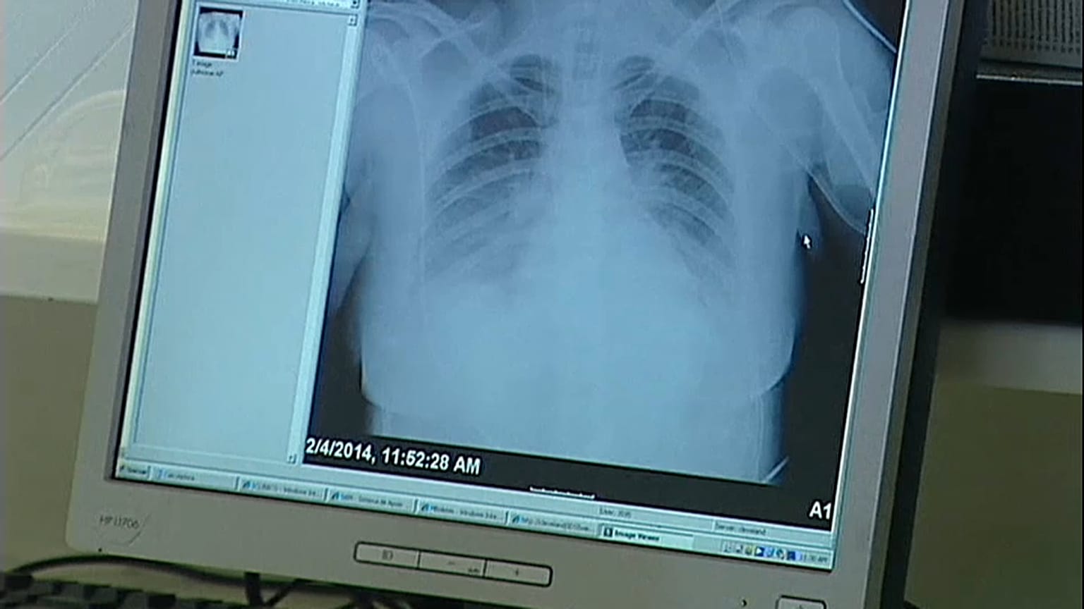 Pacientes com cancro de pulmão vivem mais com imunoterapia