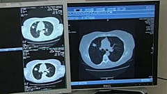Борьба с онкологией: первые успехи иммунотерапии