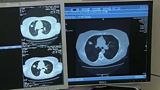 Борьба с онкологией: первые успехи иммунотерапии