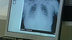 Nuevo tratamiento contra el cáncer de pulmón
