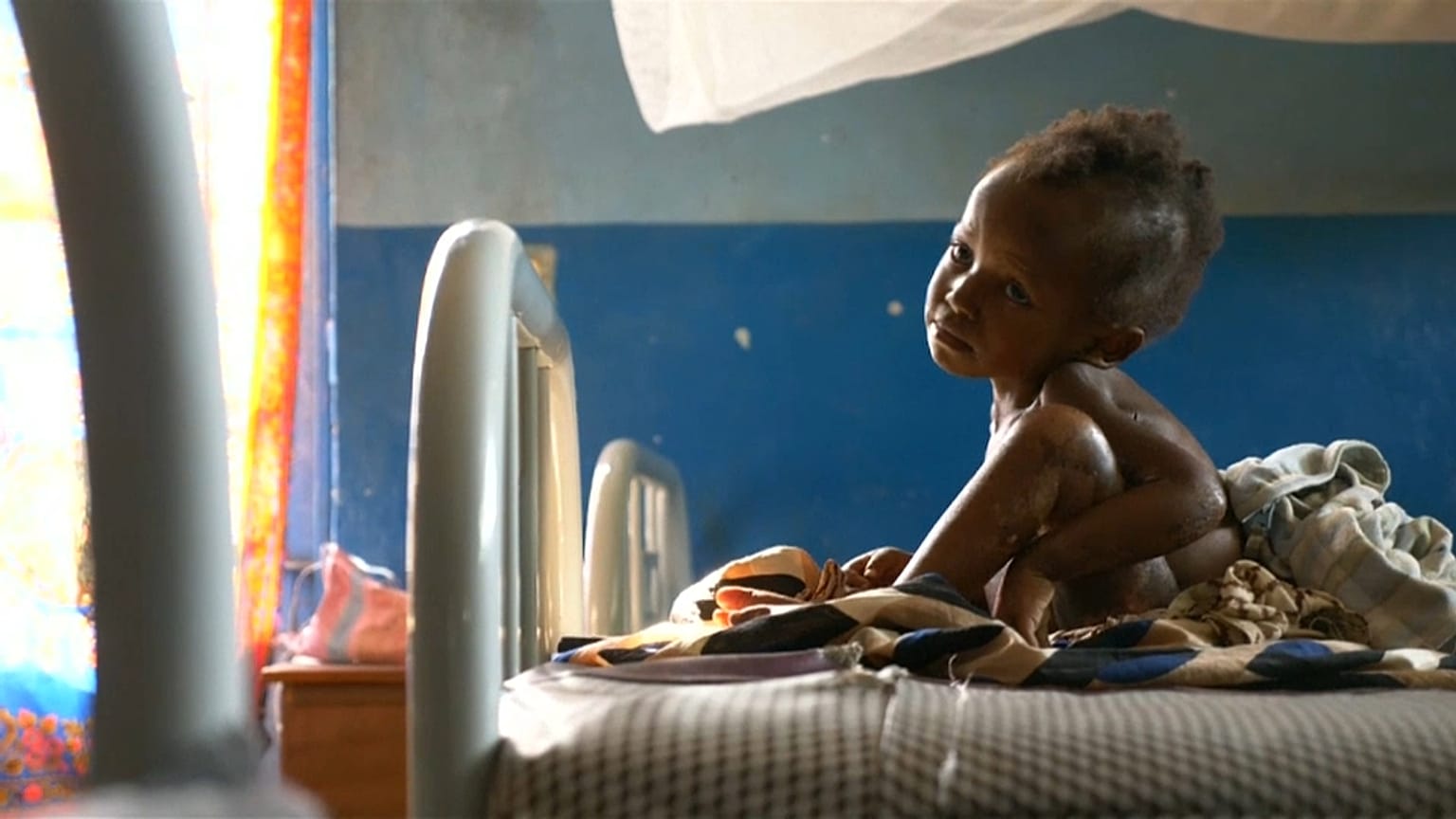 Kasaï : des enfants malnutris par centaines de milliers