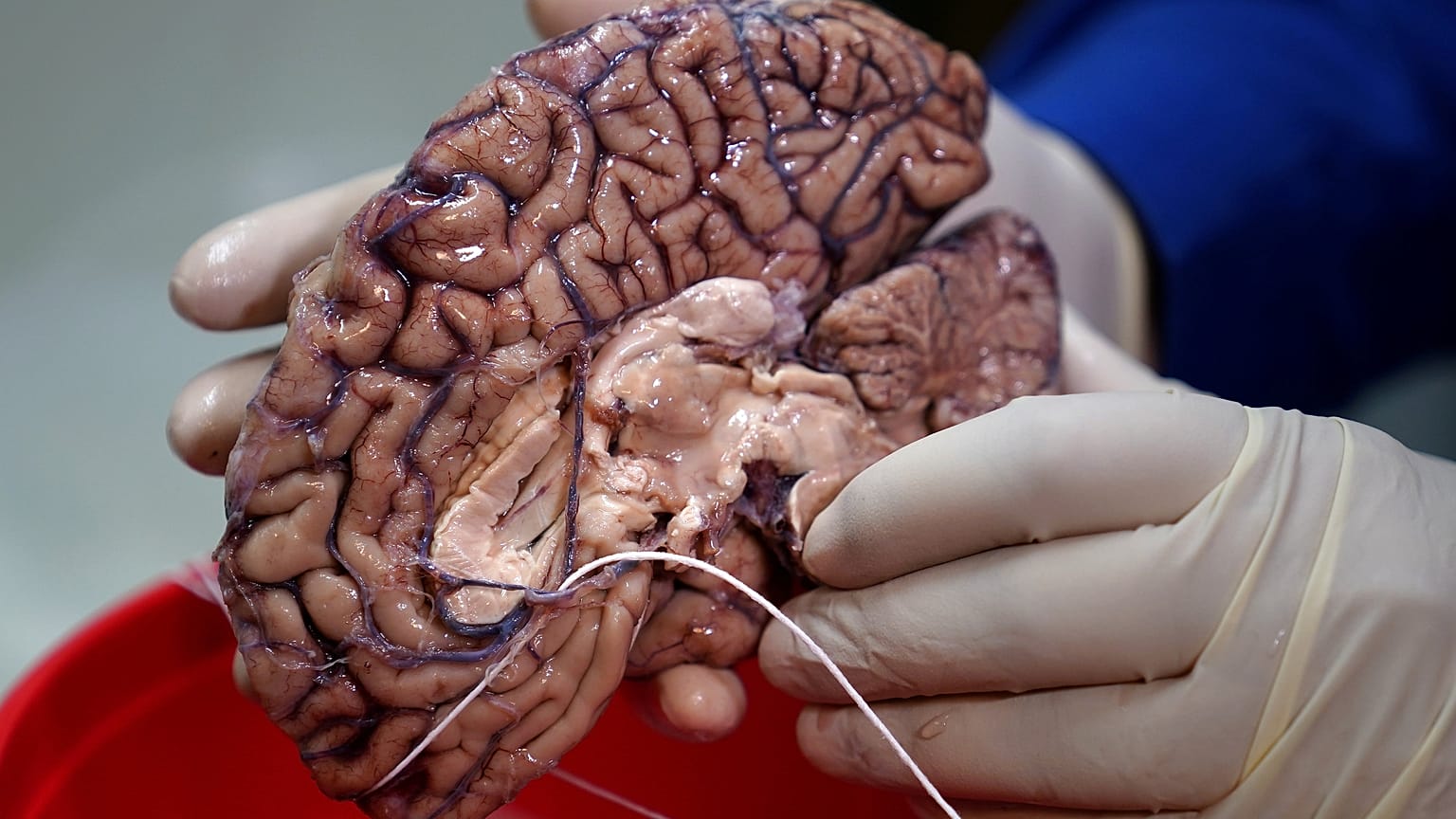 Médicos españoles logran aumentar la vida de pacientes con metástasis cerebral de 4 a 15 meses