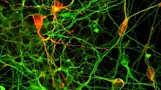 Soigner Parkinson grâce aux cellules souches
