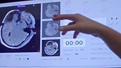 Θεραπεία της επιληψίας με laser και στην Ευρώπη