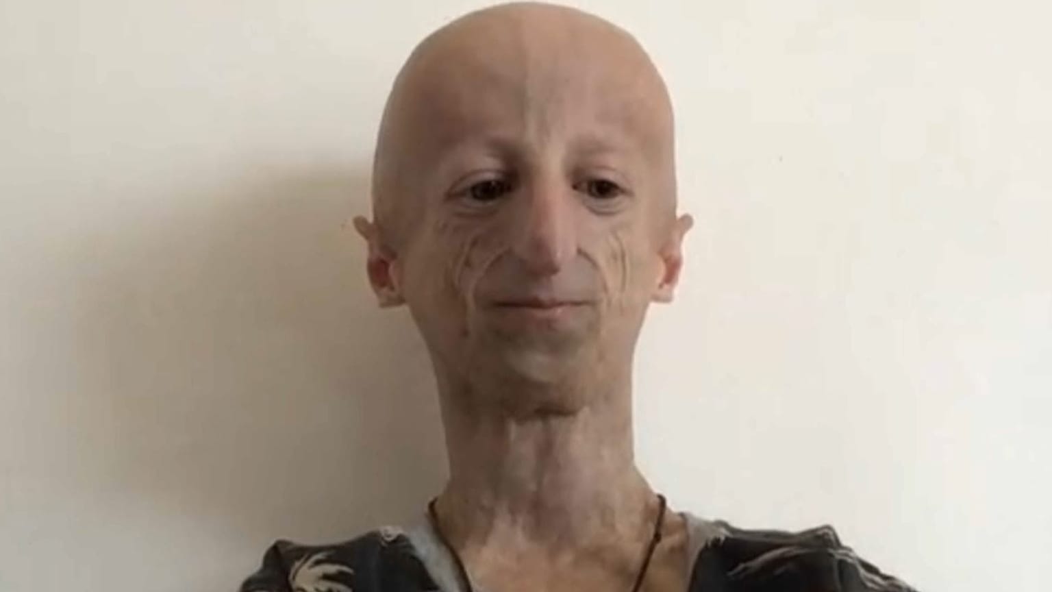 İki yaşında Progeria tanısı konulan Sammy hastalığı hakkında tez yazdı.