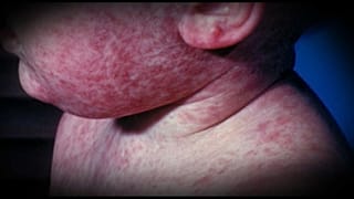 OMS, morbillo: Italia da record