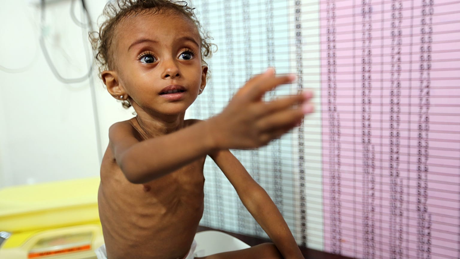 Feryal Eliyas isimli Yemenli kız çocuğu hastanede tedavi görüyor