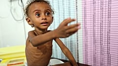 Feryal Eliyas isimli Yemenli kız çocuğu hastanede tedavi görüyor