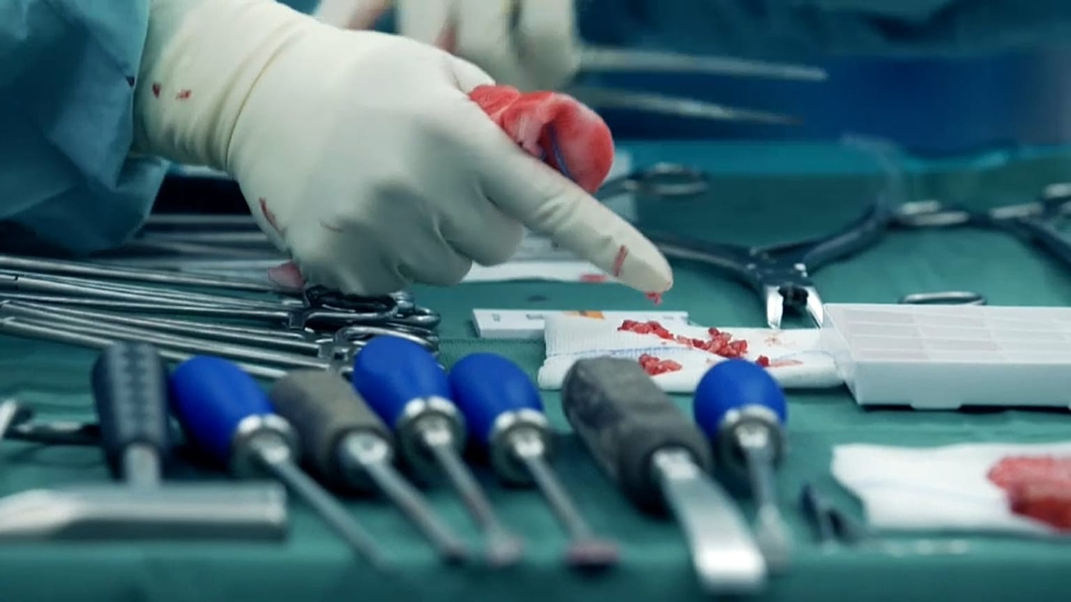 Gefährliche Implantate? Recherche deckt gravierende Mängel auf