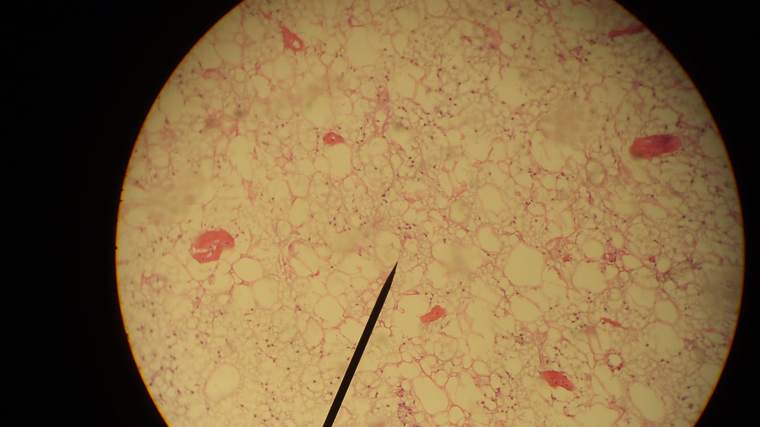 Liposarcoma