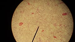 Liposarcoma