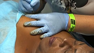 Márcia Verónica de Souza durante a reconstrução da aréola do mamilo