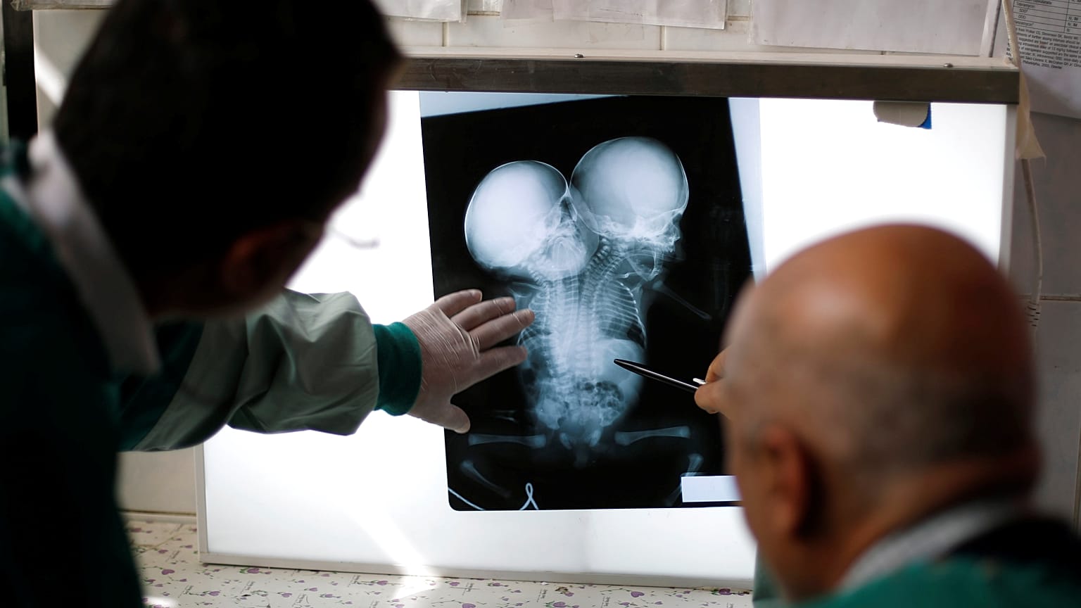 صورة تخطيط الصدى (الأشعة الصوتية) للتوأمين اليمنيين