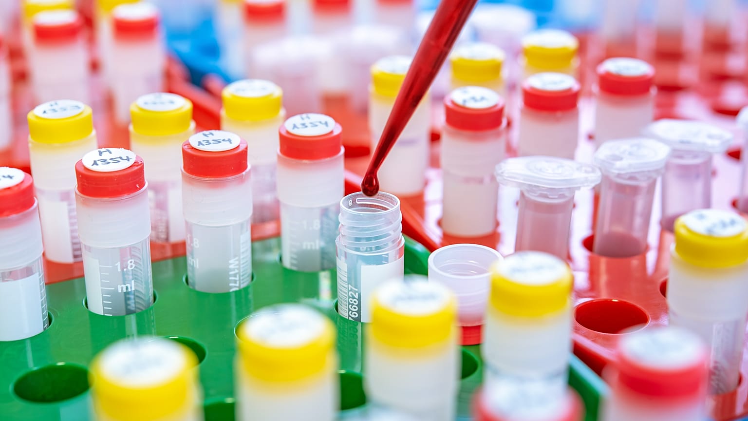 German hospital apologises for 'false hope' over new 'non-invasive' breast cancer blood test