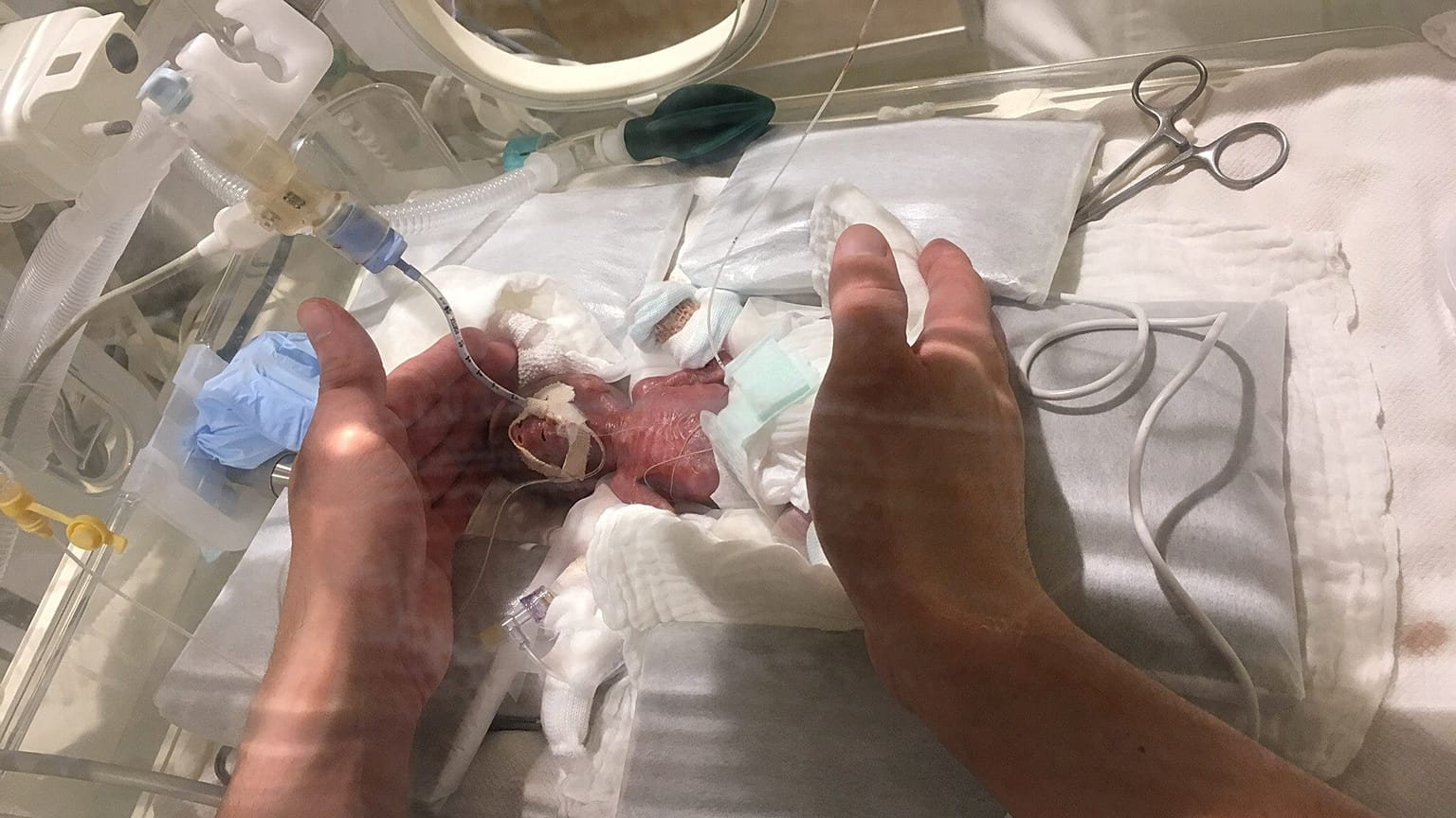 Γεννήθηκε με βάρος μόλις 268 γραμμάρια και κατόρθωσε να επιζήσει!!!