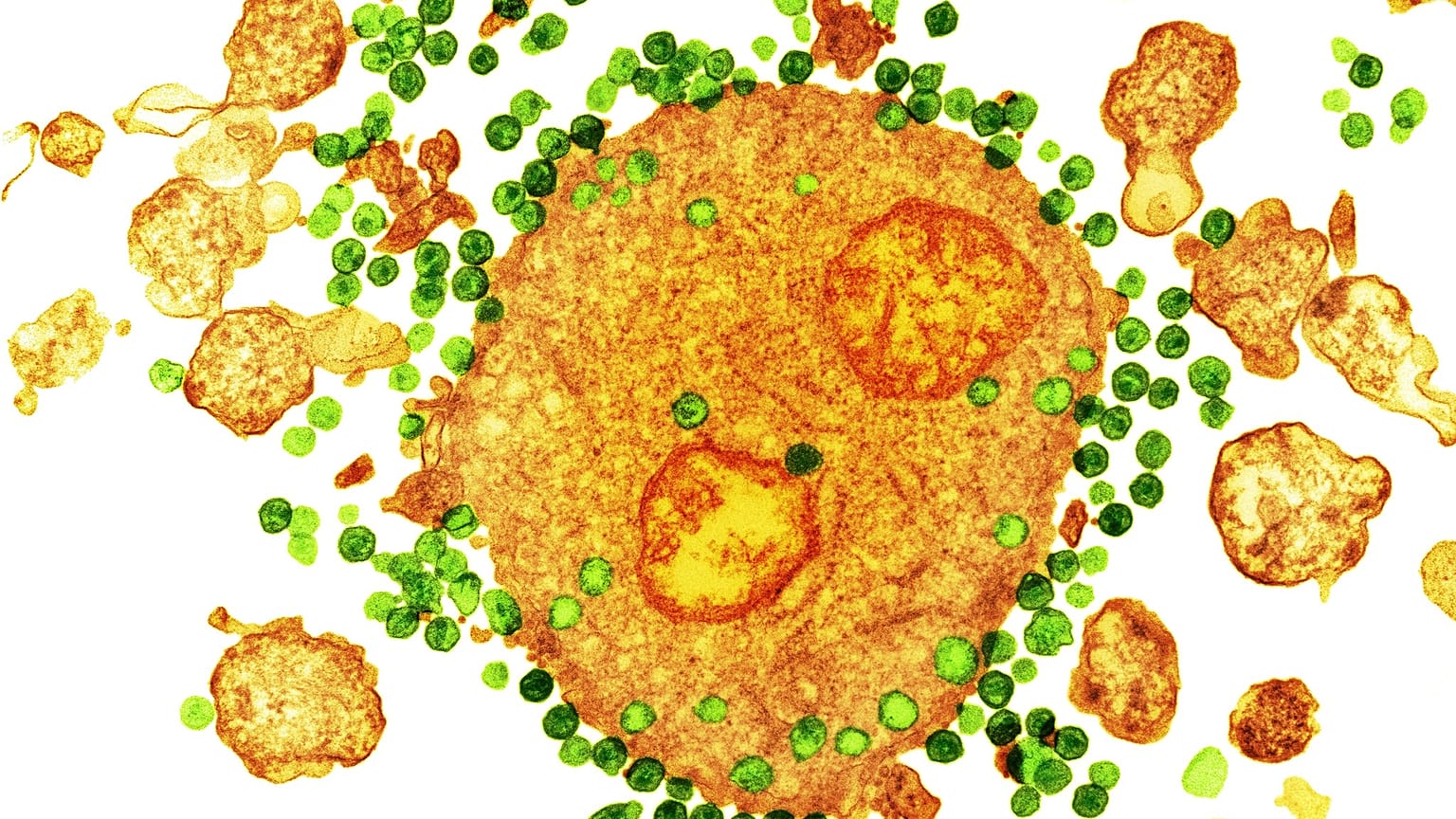 AIDS hastaları için umut artıyor: İkinci bir hasta HIV virüsünden tamamen kurtuldu