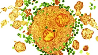 AIDS hastaları için umut artıyor: İkinci bir hasta HIV virüsünden tamamen kurtuldu