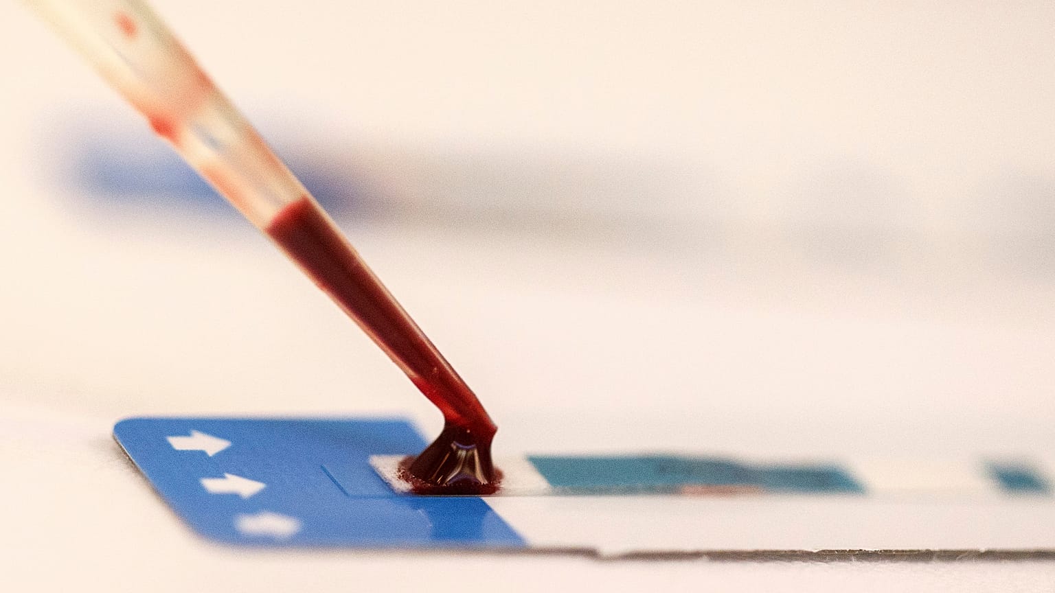 Médicos apontam para cura de segundo paciente com HIV