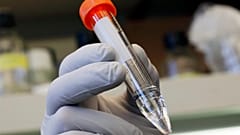 AIDS: másodszor is hatékony volt az őssejtkezelés