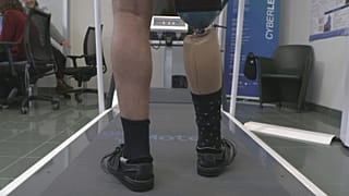 Robotische Prothesen verbessern die Lebensqualität von Amputierten