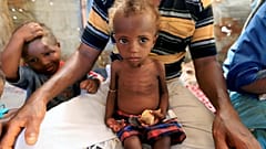 Yemen'in Hudeyde kentinde kötü beslenme nedeniyle hastalanan çocuk