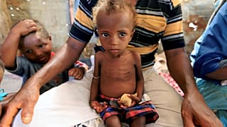 Yemen'in Hudeyde kentinde kötü beslenme nedeniyle hastalanan çocuk