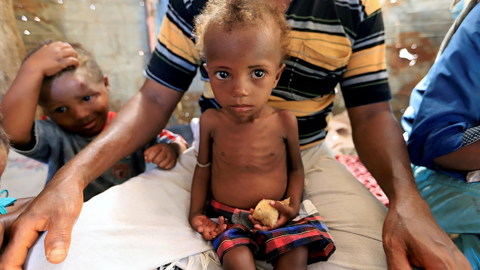 A malnourished girl sits on her father's lap in Hodeidah, Yemen