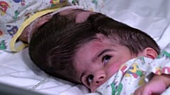 Zwillingsmädchen Safa und Marwa: Am Kopf zusammengewachsen