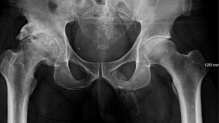 Diz ağrısı şikayetiyle doktora gitti, penisinin tamamen kemikleştiğini öğrendi: Peyronie hastalığı