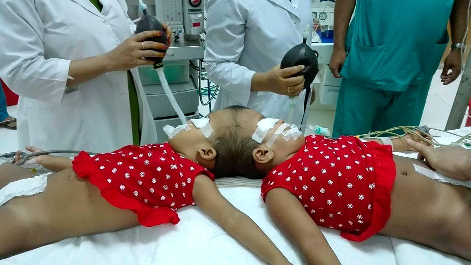 Stabil az állapota a bangladesi kislánynak, akit magyar orvosok választottak el sziámi testvérétől 