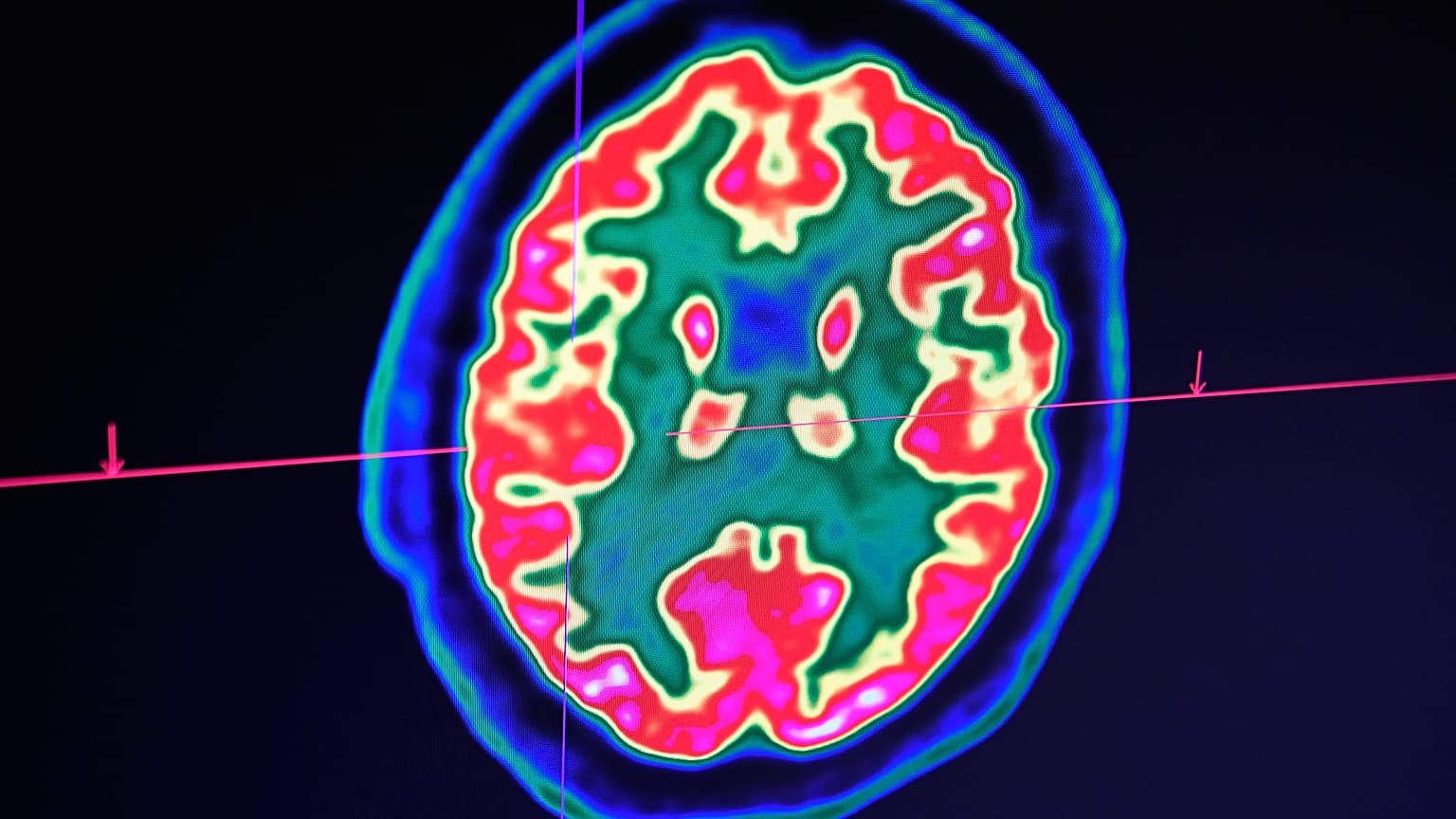 Brain scan