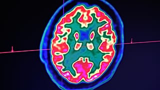 Brain scan