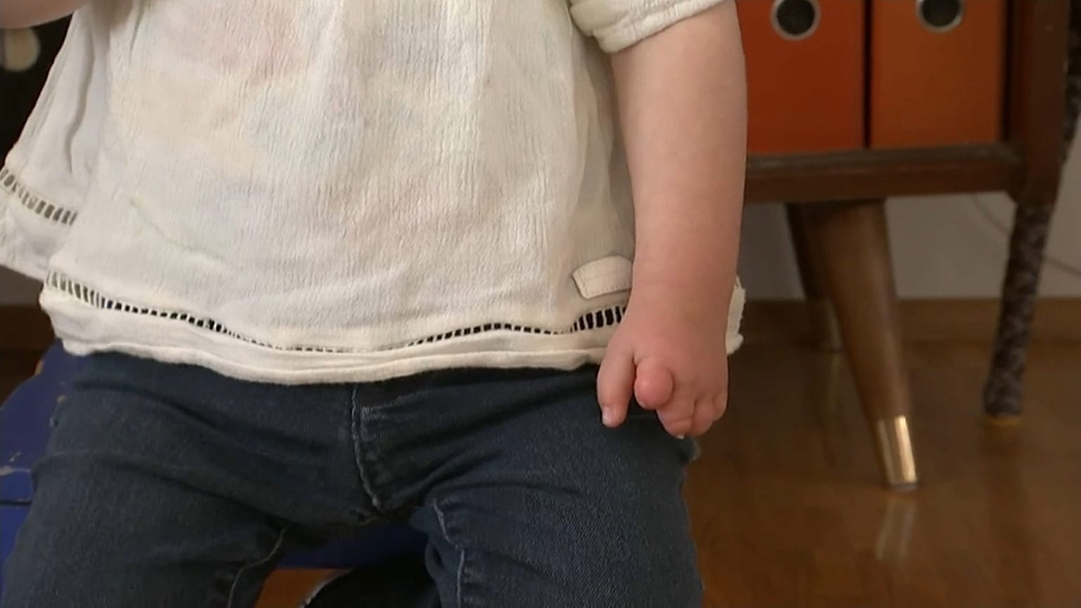 Fehlgebildete Hand eines Kindes