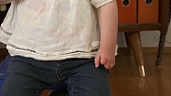 Fehlgebildete Hand eines Kindes