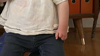 Fehlgebildete Hand eines Kindes