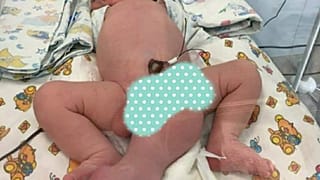 Rusya'da üç bacaklı, iki penisli bebek dünyaya geldi 