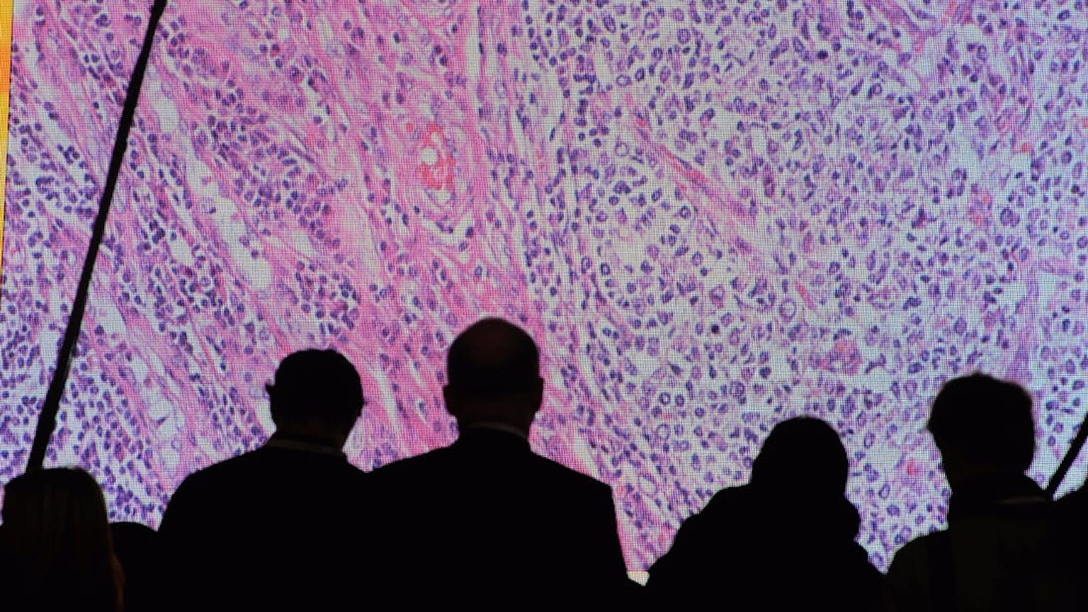 Anüs kanseri nedir? Belirtileri ne şekilde ortaya çıkar? 