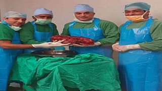 شاهد: أطباء في الهند يستأصلون كلية مريض تزن 7.5 كيلوغرام
