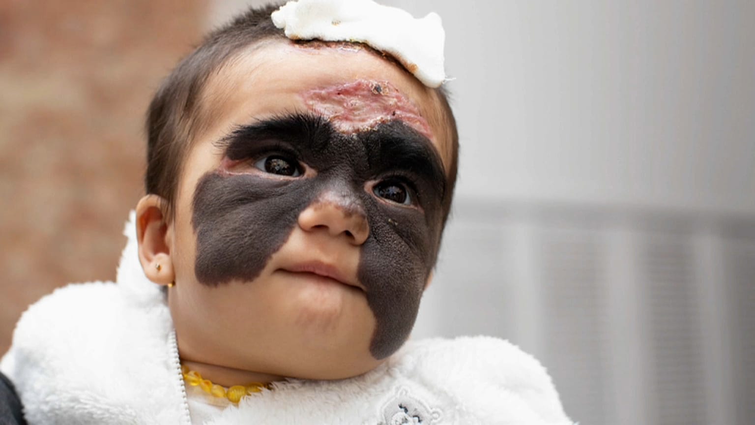 La tache noire sur le visage de la petite Luna commence à disparaître