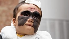 La tache noire sur le visage de la petite Luna commence à disparaître