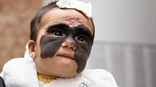 La tache noire sur le visage de la petite Luna commence à disparaître