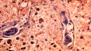 Tüdőrákkal diagnosztizált beteg szövetmintája egy 1964-ben készült mikroszroszkopikus felvételen