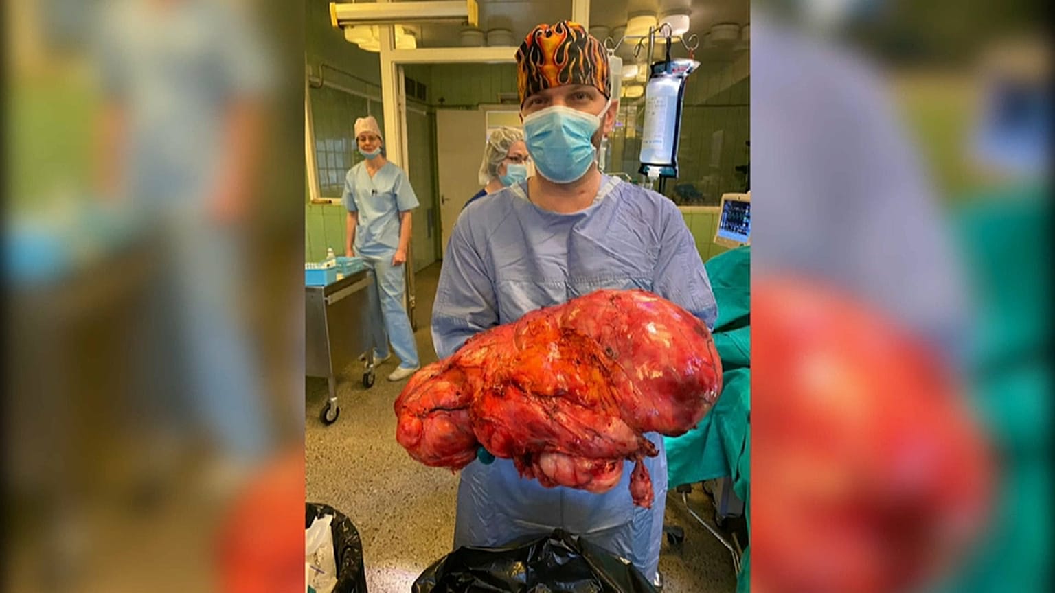 Letonya'da bir kanser hastasından 15 kg'lık timör çıkartıldı 