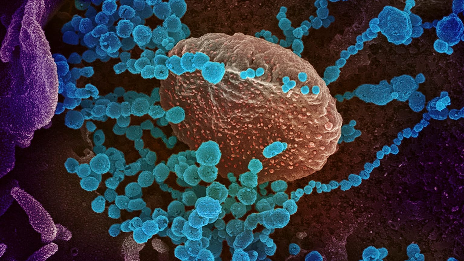 El nuevo coronavirus (en azul) surge de células cultivadas en laboratorio. El virus obtenido de un paciente estadounidense.