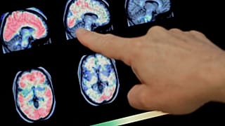 یافته جدید محققان در خصوص تاثیر مخرب ویروس کرونا بر مغز