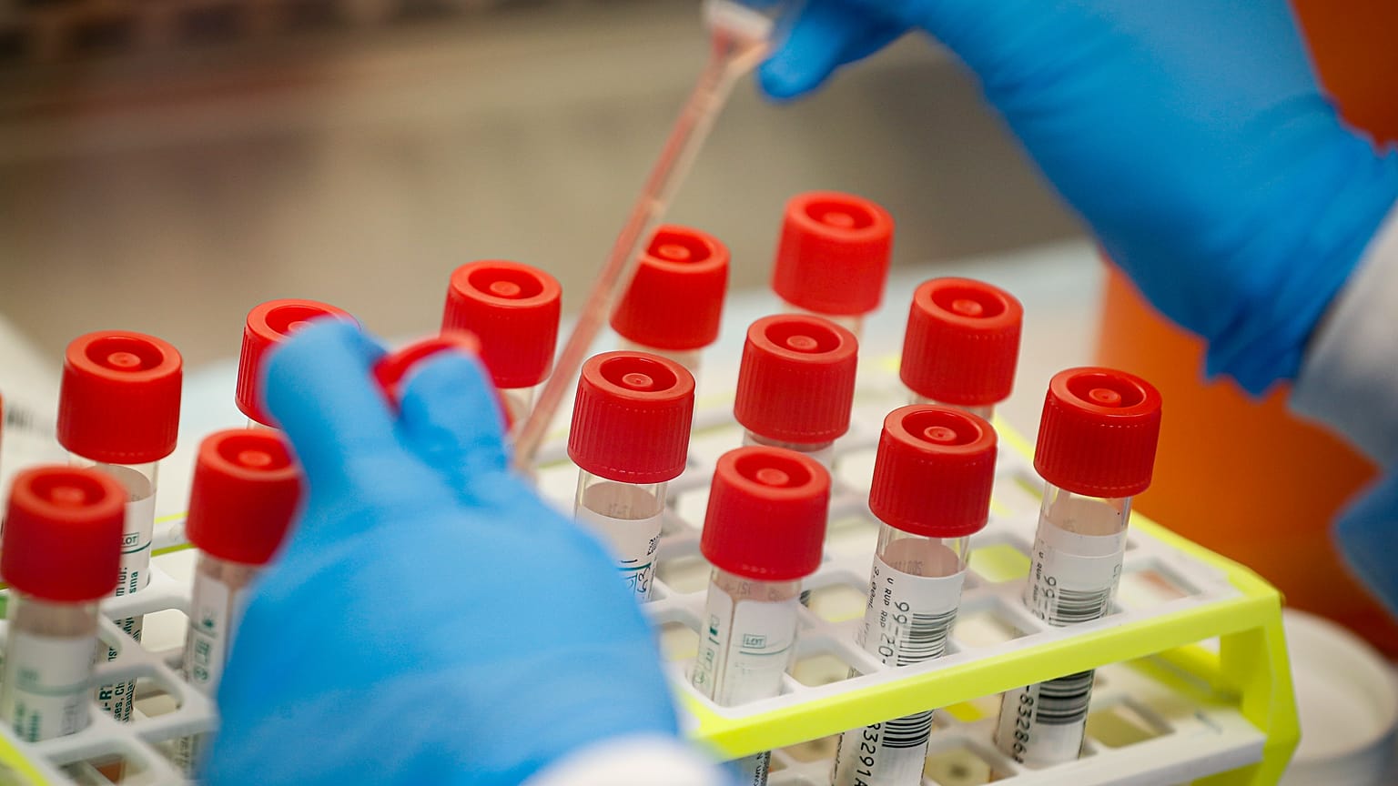 A technician prepares COVID-19 coronavirus patient samples for testing at a laboratory in New York's Long Island. 
