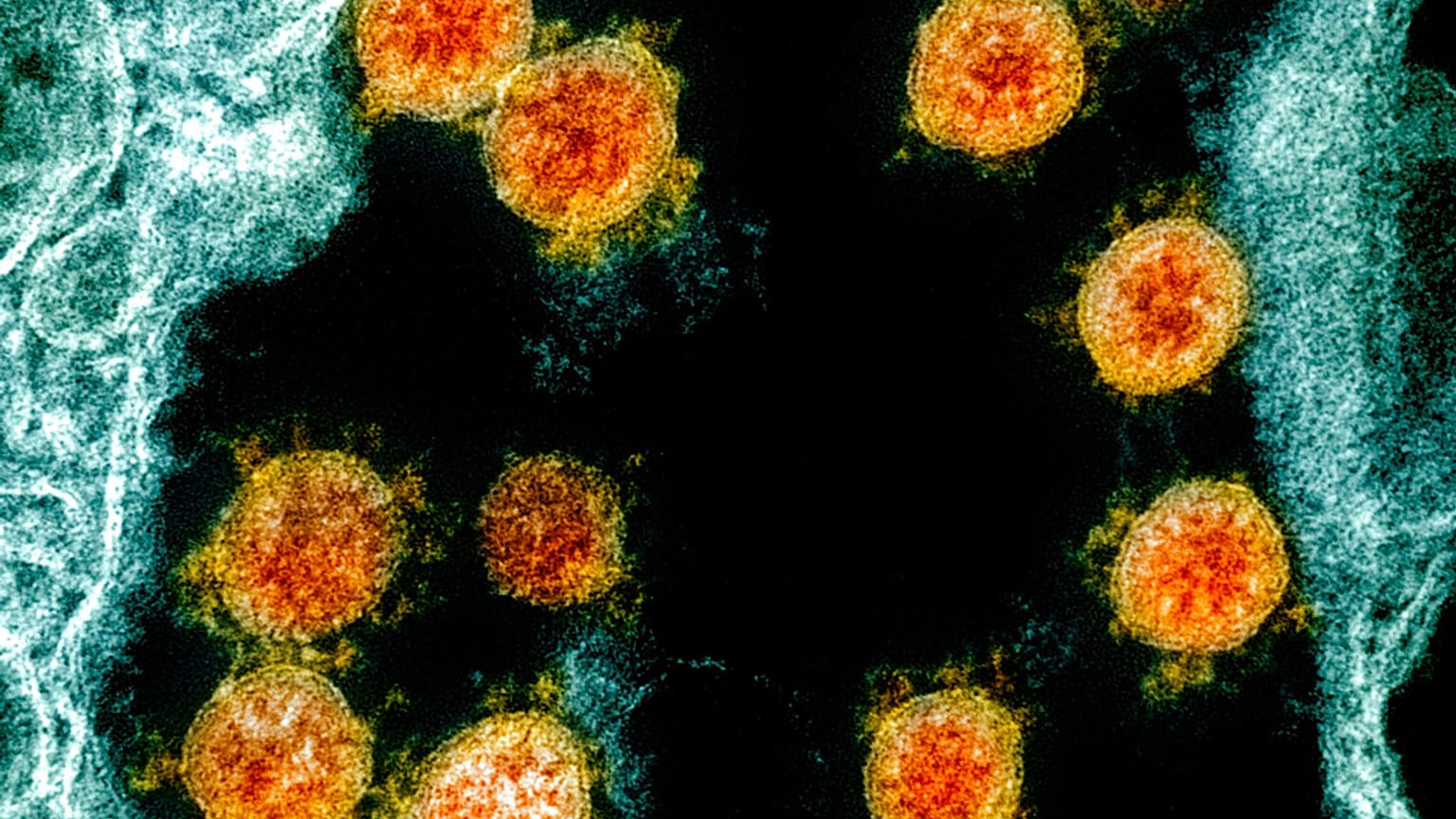 This electron microscope image shows Novel Coronavirus SARS-CoV-2 virus particles, orange, isolated from a patient. (NIAID/National Institutes of Health via AP)