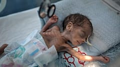 طفل حديث الولادة يعاني من سوء التغذية في حاضنة في مستشفى في صنعاء، اليمن. 