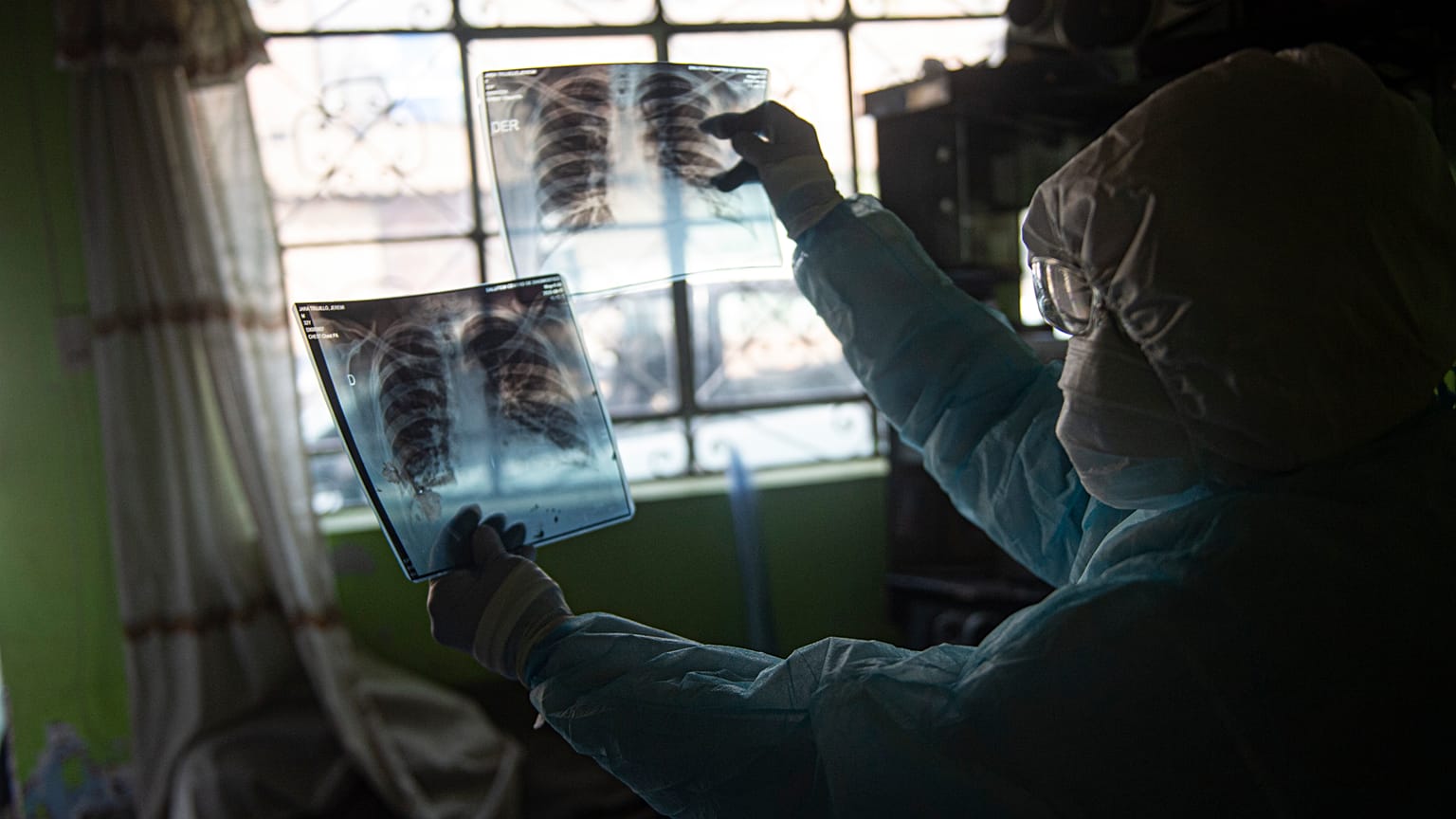 koronavirüs hastalarının akciğer görüntüleri 